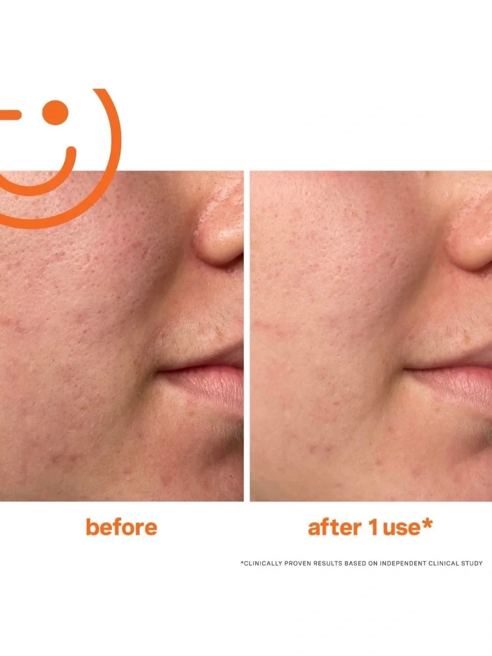 KATE SOMERVILLE ExfoliKate Intensive Exfoliating Treatment Mini 7.5ml (6pcs)